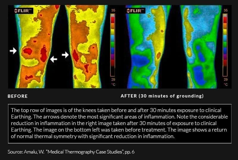 Thermographic_studies_knees_afte_3
